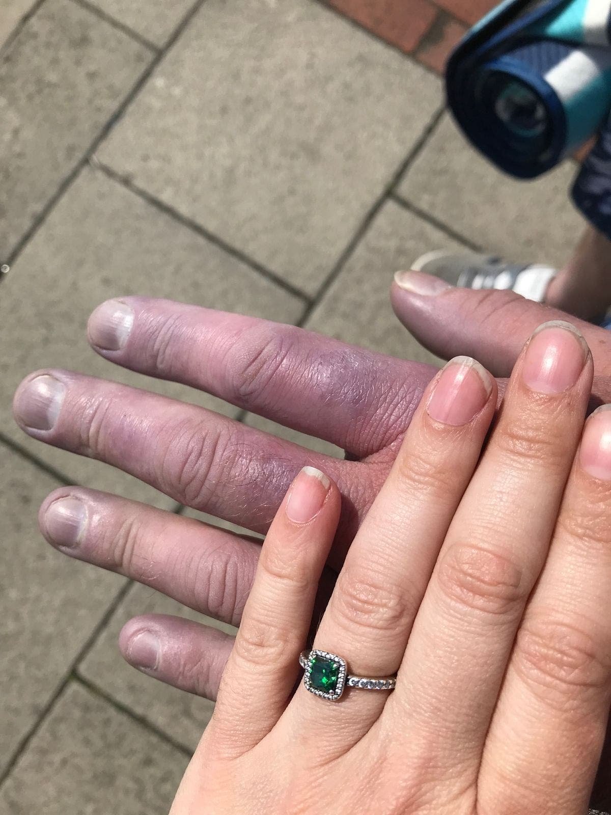 Scleroderma: Dad given two years to live after cold fingers turns out to be rare condition Scleroderma: Dad given two years to live after cold fingers turns out to be rare condition