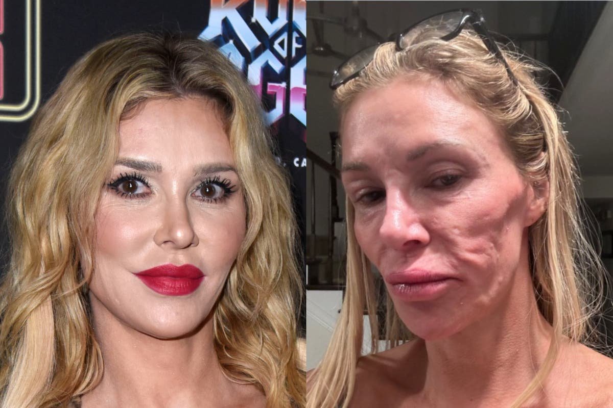 Brandi Glanville lifts lid on k treatment to remove ‘parasite’ moving in her face
