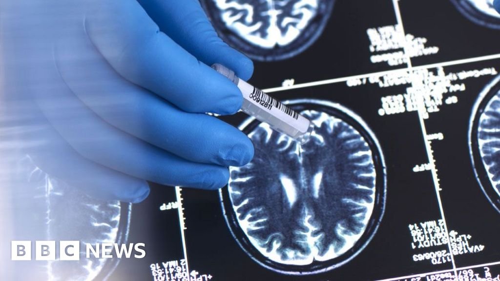 NHS will not fund new drug to slow Alzheimer’s