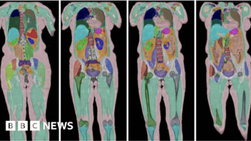 Biggest human imaging study scans 100,000th UK vol…