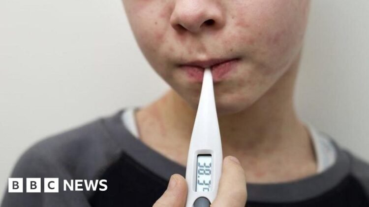 Why are measles cases rising in the UK and who can get the MMR vaccine? Why are measles cases rising in the UK and who can get the MMR vaccine?