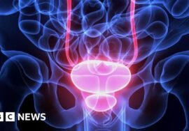 Men being over-treated for prostate cancer, says charity