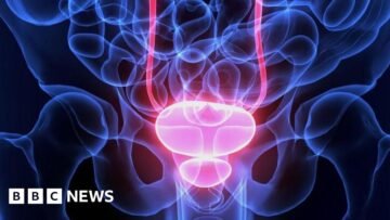 Men being over-treated for prostate cancer, says c…