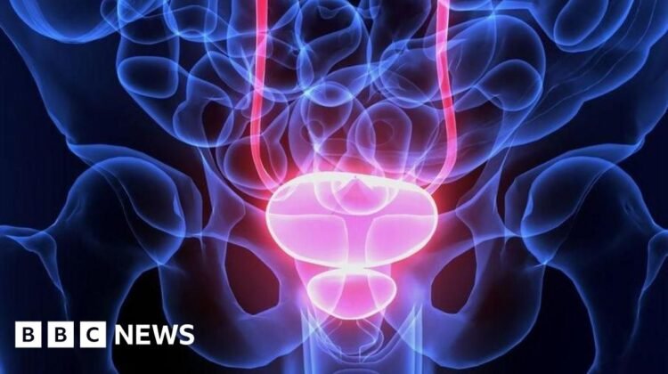 Men being over-treated for prostate cancer, says charity