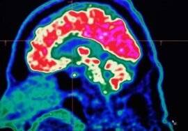 What are all these microplastics doing to our brains?
