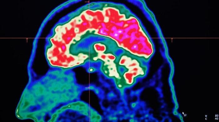 What are all these microplastics doing to our brains?